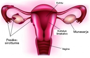 Endometrioosin pääoireet
