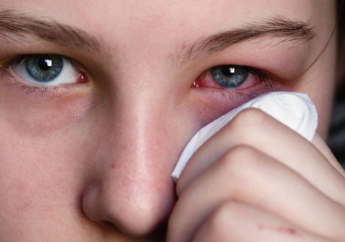 Allergiat voivat saada silmät punoittamaan.