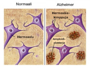 Ruokia, jotka ehkäisevät alzheimerin tautia