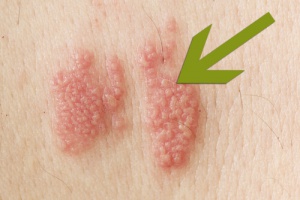 Vyöruusu - mikä se on ja miltä se näyttää?