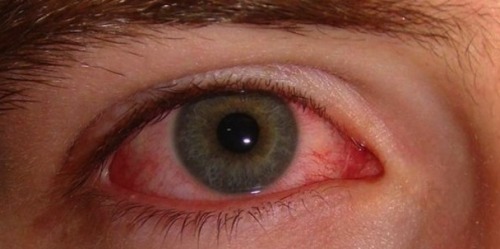 Silmien punoitus - syyt ja hoitokeinot