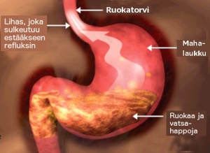 Sopiva ruokavalio refluksista kärsiville