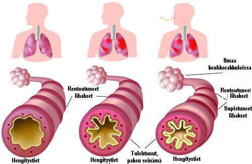 Krooninen astma ja allergiat – mikä avuksi?