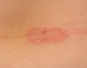 Jalkasilsan ehkäisy