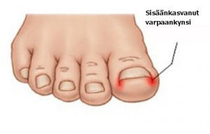 Ennaltaehkäise sisäänkasvaneet varpaankynnet