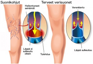 Suonikohjujen ennaltaehkäisy ja hoito