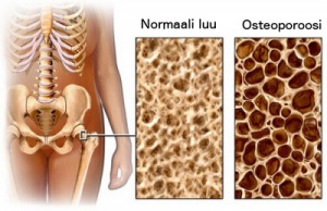 Osteoporoosin torjuminen ruokavalion avulla