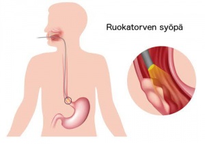 Merkittävimpien ruokatorvisairauksien oireet