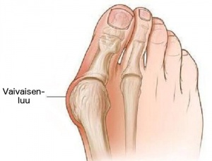 Ehkäise vaivaisenluun muodostuminen