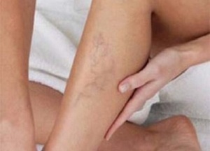 Mikä avuksi heikkoon verenkiertoon?