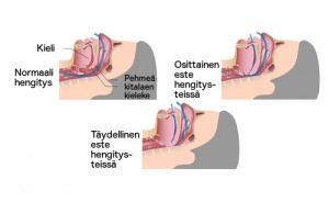 Hoitokeinot kuorsaamiseen