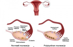Mikä on munasarjojen monirakkulaoireyhtymä ja miten sitä hoidetaan?