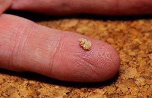 Mikä aiheuttaa munuaiskivet?