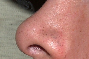 7 vinkkiä, joilla pääset nopeasti eroon mustapäistä