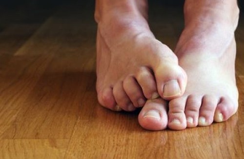 Kotihoidot käsien ja jalkojen kynsisieneen