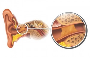 Poista korvavaikku luonnollisesti