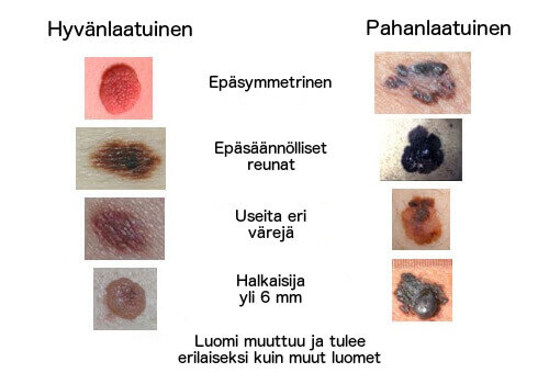 On tärkeää tunnistaa, milloin luomi on epänormaali.