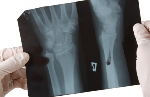 Ruuat, jotka vahingoittavat luuston terveyttä