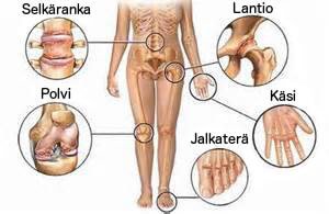 Heitä hyvästit nivelkivuille - 5 lievityskeinoa