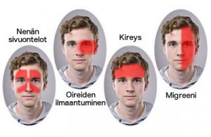 Uusi tehokas hoito, jonka on havaittu hoitavan migreeniä