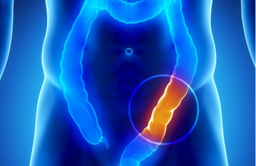 Paksusuolisyöpää voi ehkäistä oikeanlaisella ruokavaliolla.