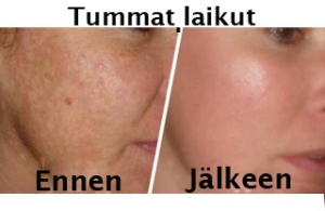 Poista ihon tummat pigmenttiläiskät