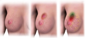 Neljä kymmenestä kasvaimesta voidaan ehkäistä