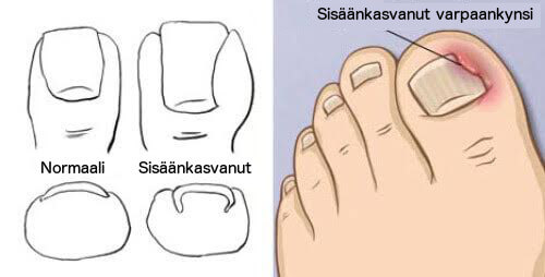 Hoitokeinoja sisäänkasvaneisiin varpaankynsiin Hoitokeinoja sisäänkasvaneisiin varpaankynsiin