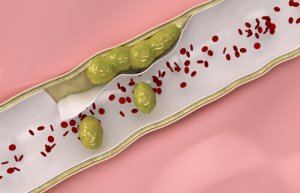 Verisuonten puhdistus luonnollisesti