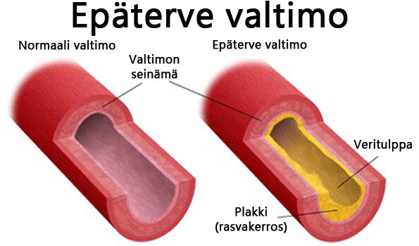 verisuonien-kalkkeutuminen