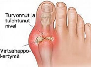 Virtsahapon vaarat - näin vältät sen kertymisen elimistöön