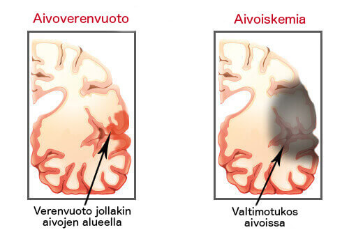 ACV: aivohalvauksen merkkejä