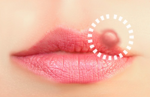 10 luonnollista hoitokeinoa huuliherpekseen