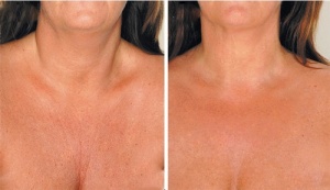 Hoitokeinot vähentämään decolté-alueen ryppyjä