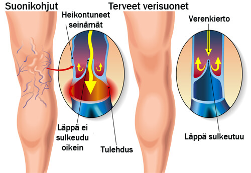 Suonikohjut ja ei suonikohjuja