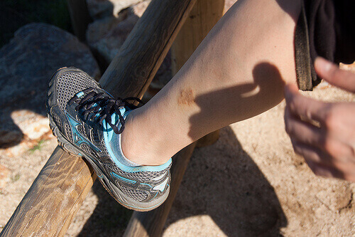 Voit päästä eroon ekseemasta luonnollisin keinoin.