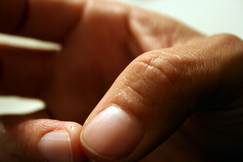 Ekseema on yleinen vaiva.