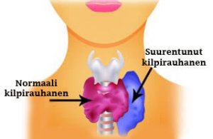 Kilpirauhasen liikatoiminta naisilla: oireet ja suositeltu ruoka - Askel  Terveyteen