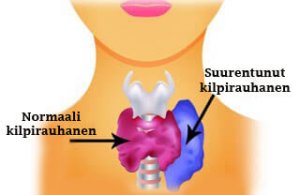 Kilpirauhasen liikatoiminta naisilla: oireet ja suositeltu ruoka
