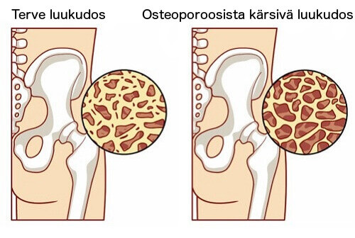 osteoporoosin oireet