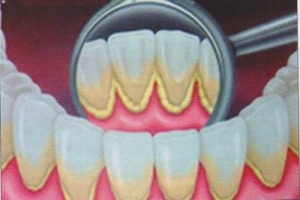 Poista plakki ja ehkäise sen muodostumista