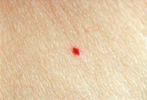 syntymämerkki ihossa