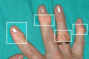 Niveltulehduksen hoito luonnollisilla keinoilla