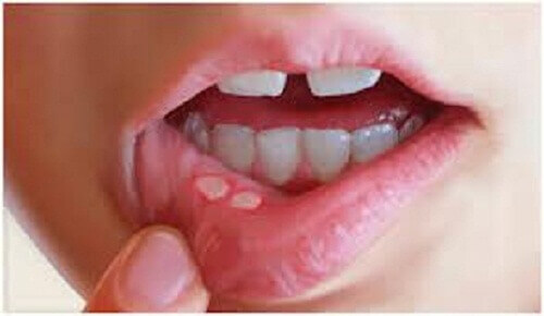 Suun rakkuloiden ehkäisy ja hoito