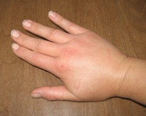 Poista turvotus näillä teeuutteilla