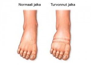 Ehkäise turvotus