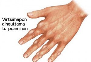 Poista virtsahappoa kehostasi luonnollisesti