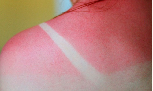 Hoida tehokkaasti auringon polttamaa ihoa