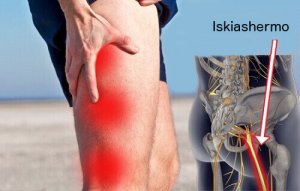 Iskiaskivun kotihoito