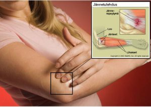 Vinkkejä jännetulehduksen hoitoon